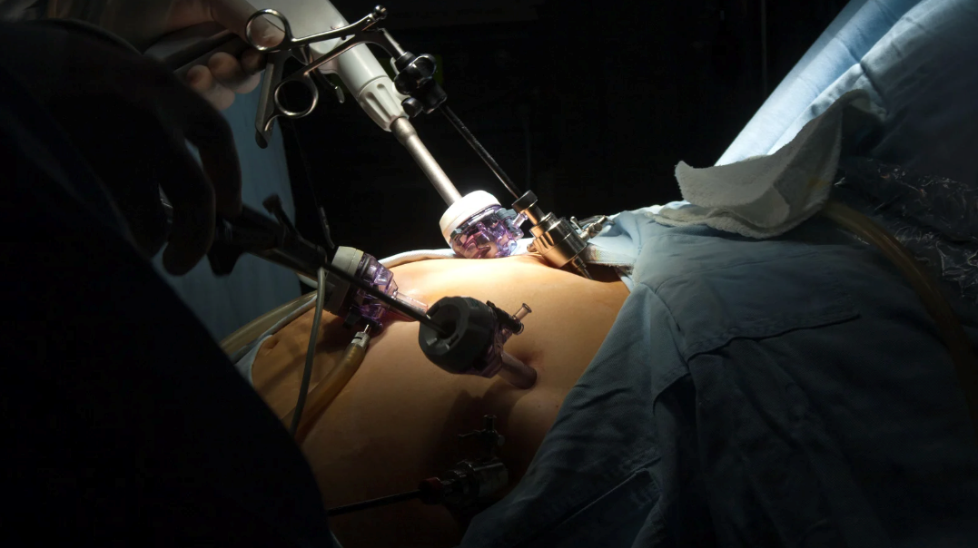 Gastric Bypass Recovery: What You Need to Know for Success