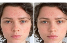 LED Face Mask Before and After: Transform Your Skin with the LED Face and Neck Mask