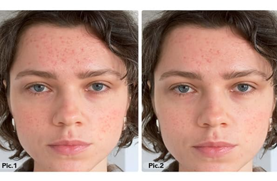 LED Face Mask Before and After: Transform Your Skin with the LED Face and Neck Mask