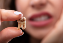Why Decay Can Still Develop Around Cosmetic Dental Restorations