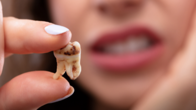 Why Decay Can Still Develop Around Cosmetic Dental Restorations