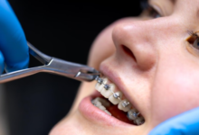 7 Measurements Orthodontists Use To Evaluate Treatment Progress