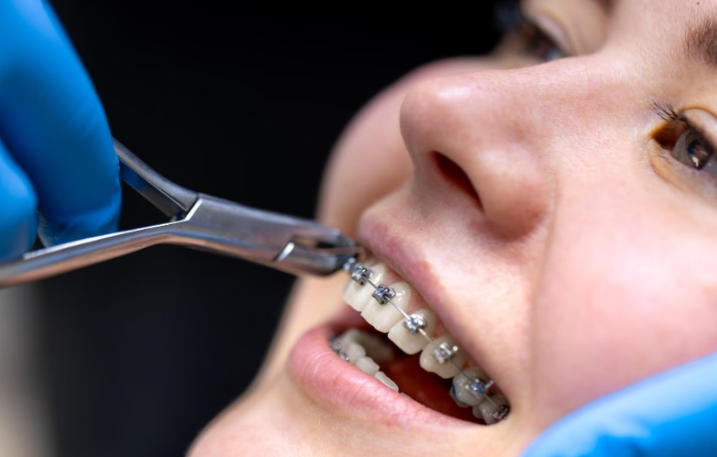 7 Measurements Orthodontists Use To Evaluate Treatment Progress